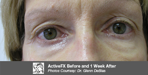 After ActiveFX