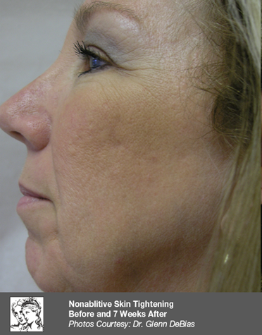 After treatment