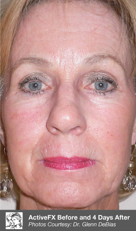After SCAARFX scar treatment