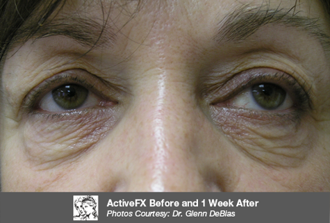 Before ActiveFX