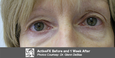 Before ActiveFX