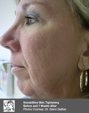 Before treatment